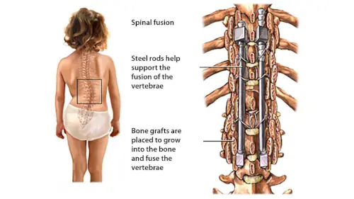 Image Explaining Spinal Fusion Surgery Procedure